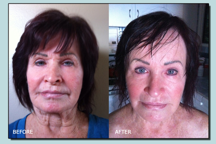 Vals Before and After